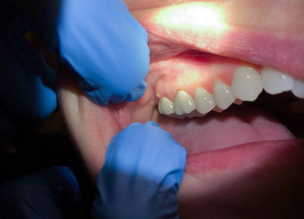 Best Emergency Tooth Extraction in Hammonton, NJ